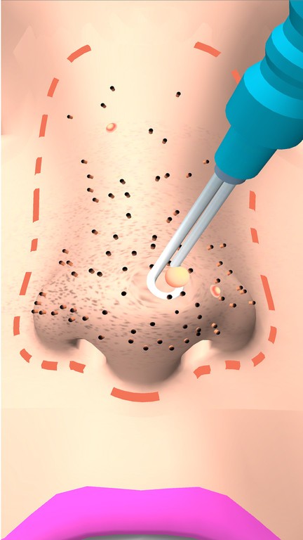 挤黑头大师游戏