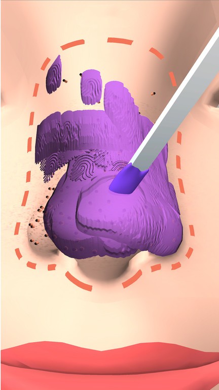 挤黑头大师游戏