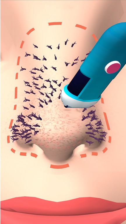 挤黑头大师游戏